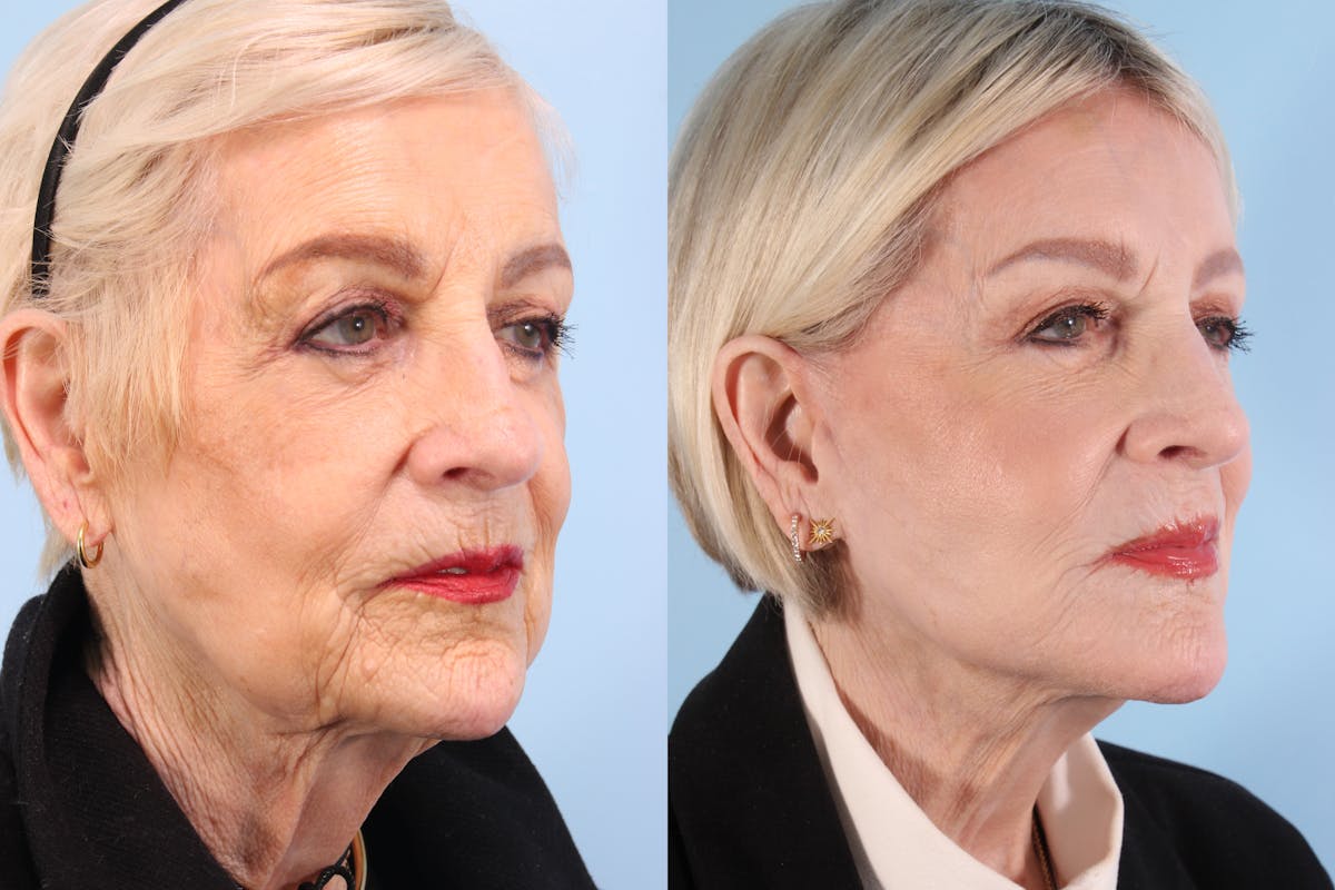 Facelift Before & After Gallery - Patient 693218 - Image 2