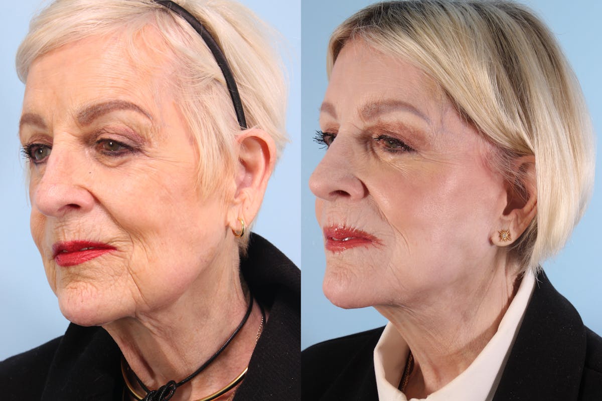 Neck Lift Before & After Gallery - Patient 126000 - Image 4