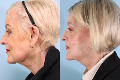 Neck Lift Before & After Gallery - Patient 126000 - Image 1