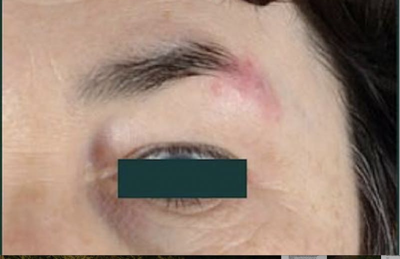 Mustache, Eyebrow Grafts Before & After Gallery - Patient 147450 - Image 1