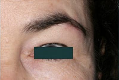 Mustache, Eyebrow Grafts Before & After Gallery - Patient 147450 - Image 2