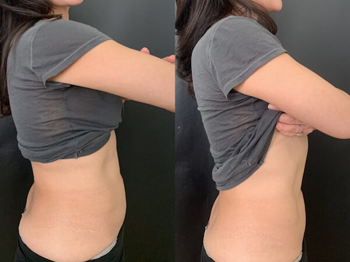 CoolTone Before & After Gallery - Patient 237123 - Image 3