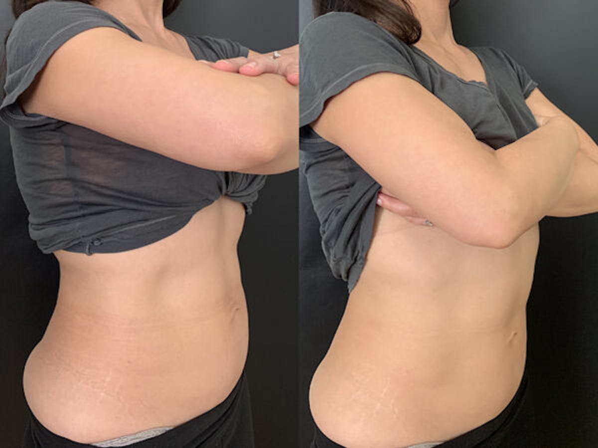 CoolTone Before & After Gallery - Patient 237123 - Image 2