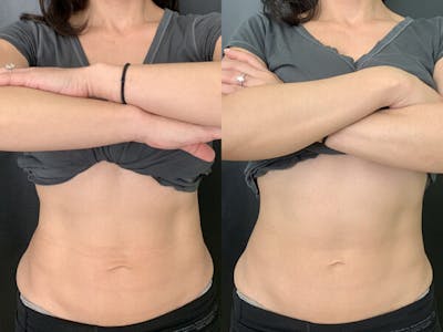 CoolTone Before & After Gallery - Patient 237123 - Image 1