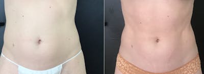 CoolTone Before & After Gallery - Patient 158521 - Image 1