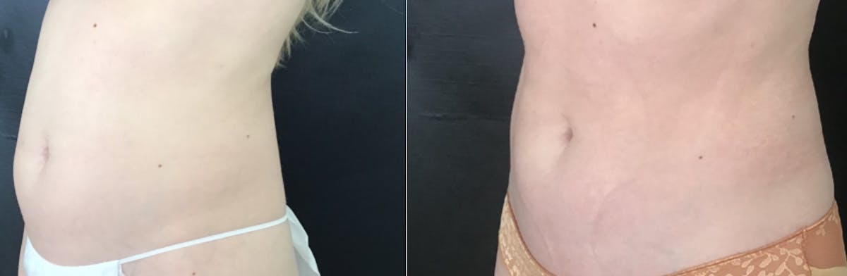CoolTone Before & After Gallery - Patient 158521 - Image 2