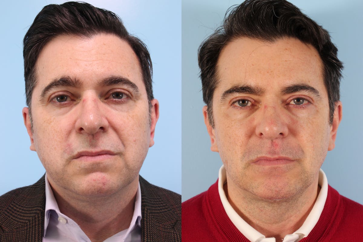 Liposuction Submental Before & After Gallery - Patient 406982 - Image 2