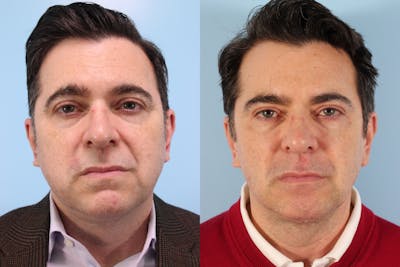 Buccal Fat Removal Before & After Gallery - Patient 251096 - Image 1