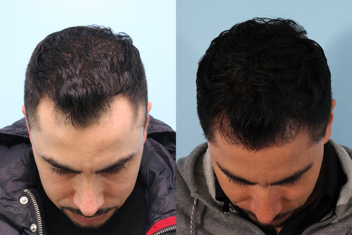 Hair Graft Surgery Before & After Gallery - Patient 115052 - Image 2