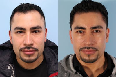 Hair Graft Surgery Before & After Gallery - Patient 115052 - Image 1