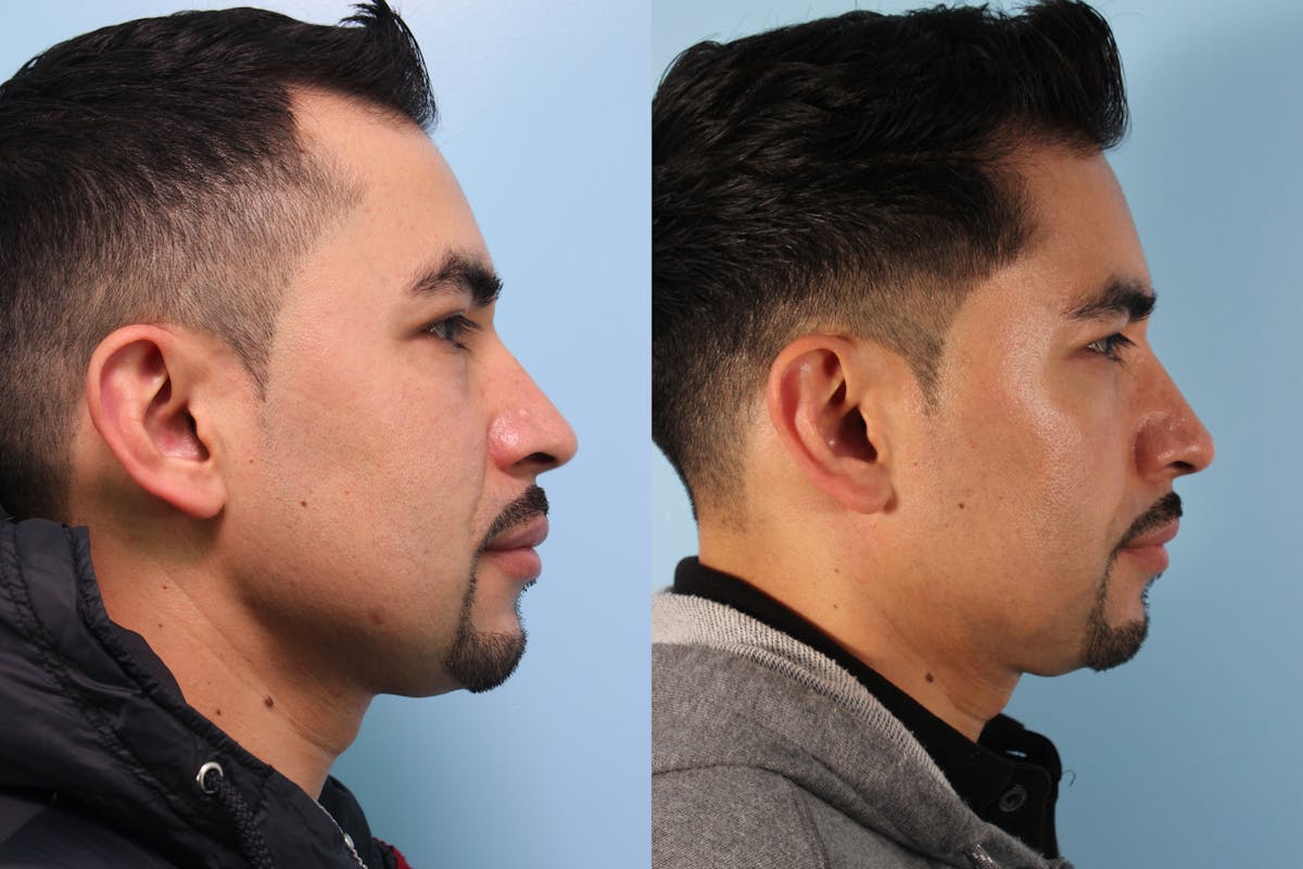Hair Graft Surgery Before & After Gallery - Patient 115052 - Image 4