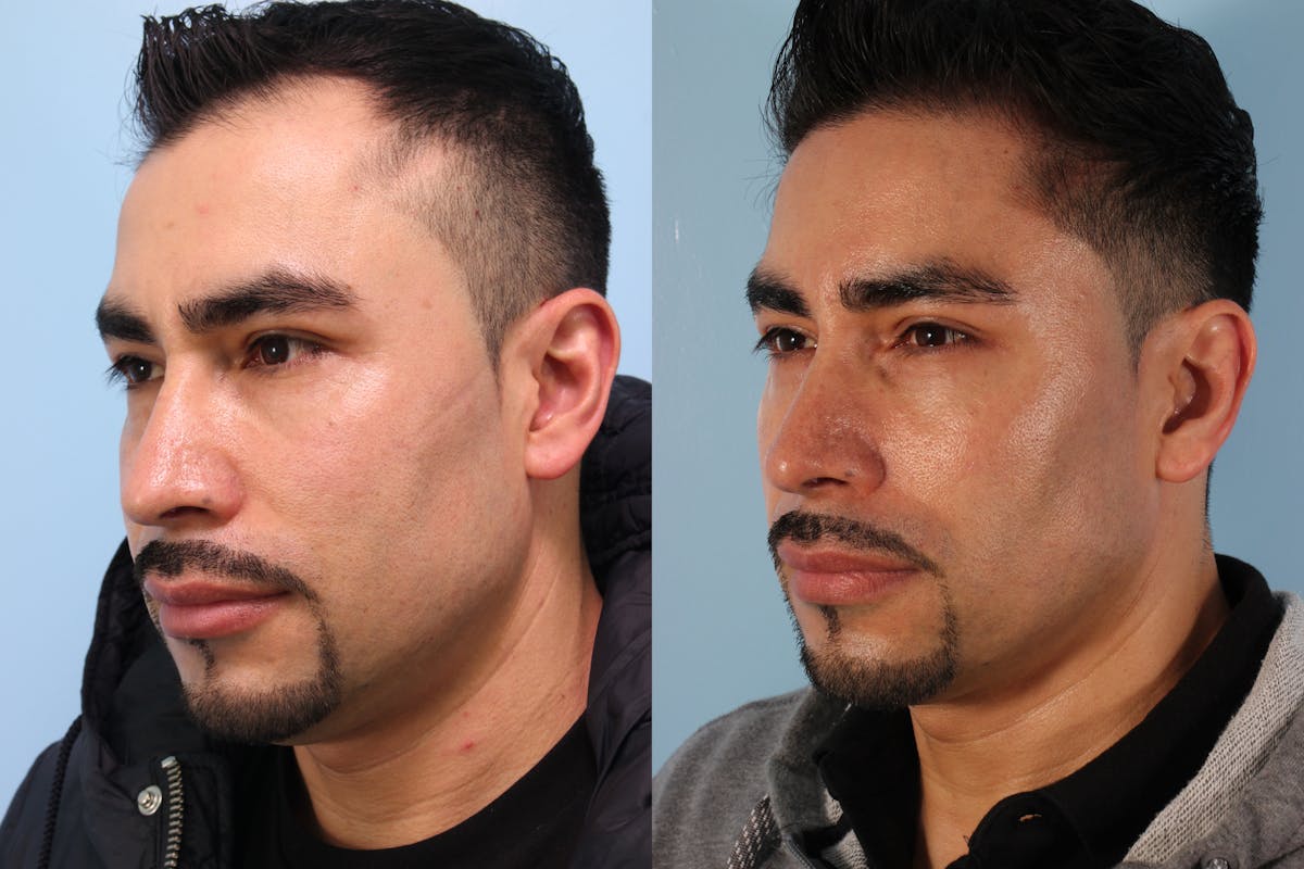 Hair Graft Surgery Before & After Gallery - Patient 115052 - Image 5