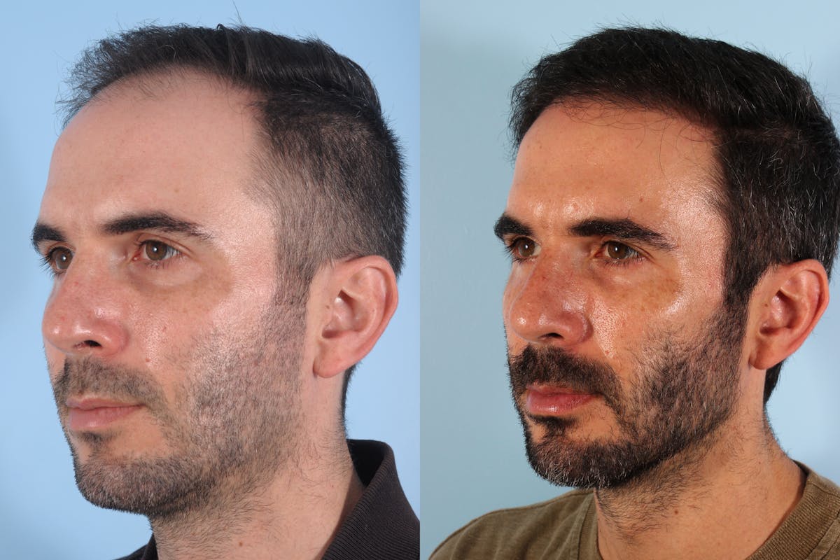 Hair Graft Surgery Before & After Gallery - Patient 640648 - Image 2