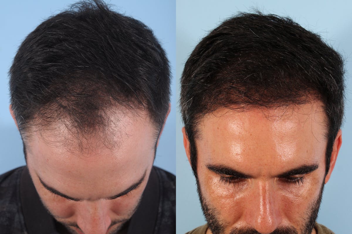Hair Graft Surgery Before & After Gallery - Patient 640648 - Image 1