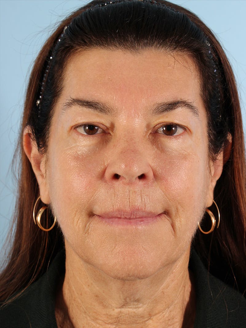 Facial Resurfacing Before & After Gallery - Patient 239646 - Image 1