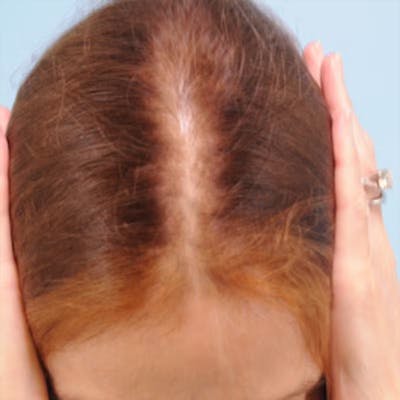 Hair Graft Surgery Before & After Gallery - Patient 270839 - Image 1
