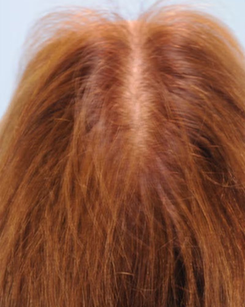 Hair Graft Surgery Before & After Gallery - Patient 270839 - Image 3