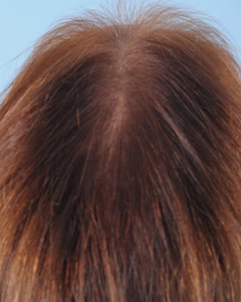 Hair Graft Surgery Before & After Gallery - Patient 270839 - Image 4
