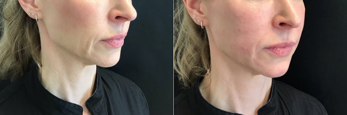 Dermal Fillers Before & After Gallery - Patient 427448 - Image 1