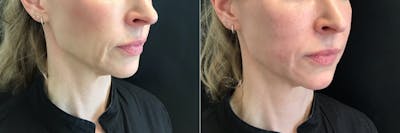 Dermal Fillers Before & After Gallery - Patient 427448 - Image 1