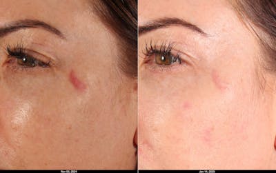Scarlet RF Microneedling Before & After Gallery - Patient 590266 - Image 1