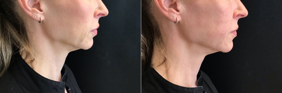 Dermal Fillers Before & After Gallery - Patient 427448 - Image 2