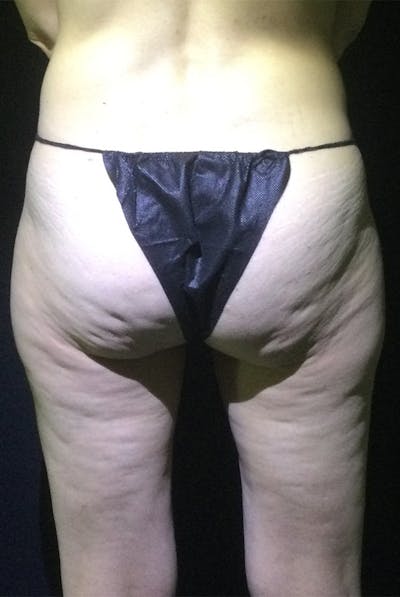 Avéli Cellulite Treatment Before & After Gallery - Patient 392978 - Image 1