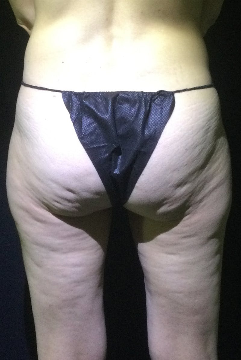 Avéli Cellulite Treatment Before & After Gallery - Patient 392978 - Image 1