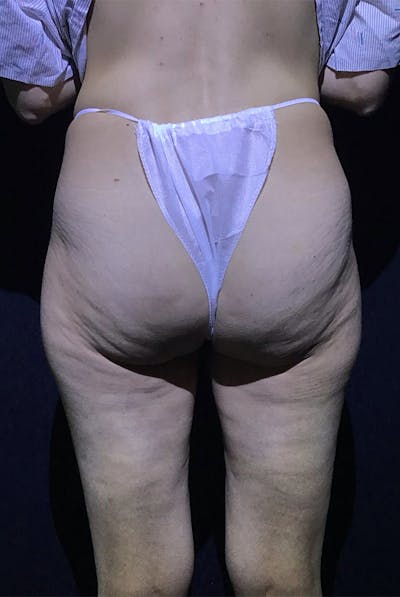 Avéli Cellulite Treatment Before & After Gallery - Patient 392978 - Image 2