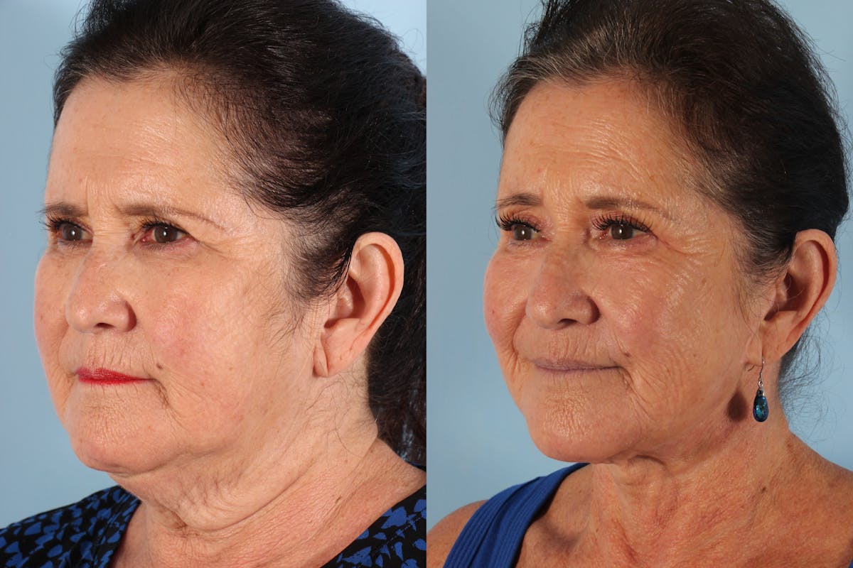 Facelift Surgery  Before & After Gallery - Patient 250754 - Image 4