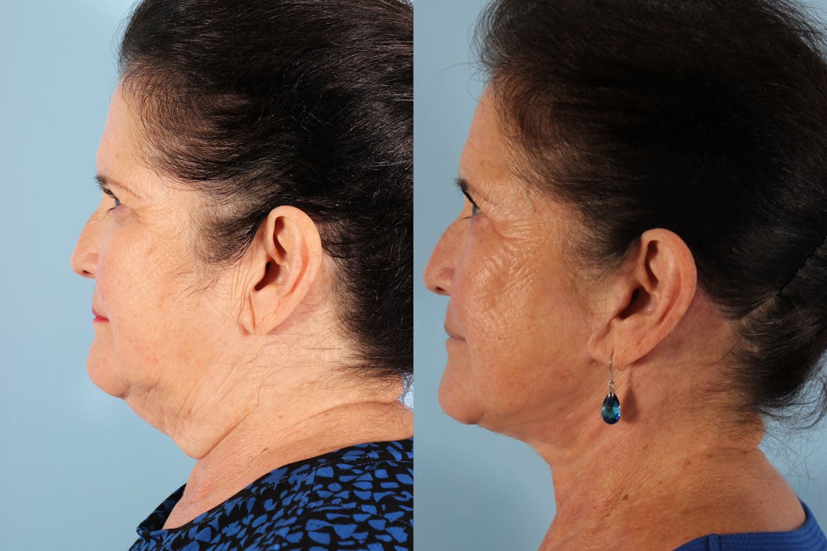Facelift Surgery  Before & After Gallery - Patient 250754 - Image 5