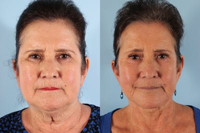 GLP-1 Weight Loss Before & After Gallery - Patient 258298 - Image 1