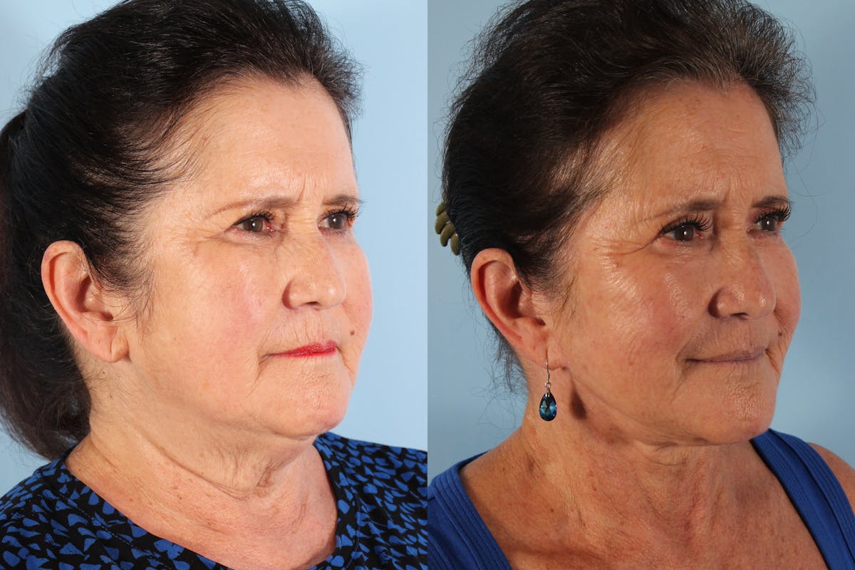 Facelift Surgery  Before & After Gallery - Patient 250754 - Image 2