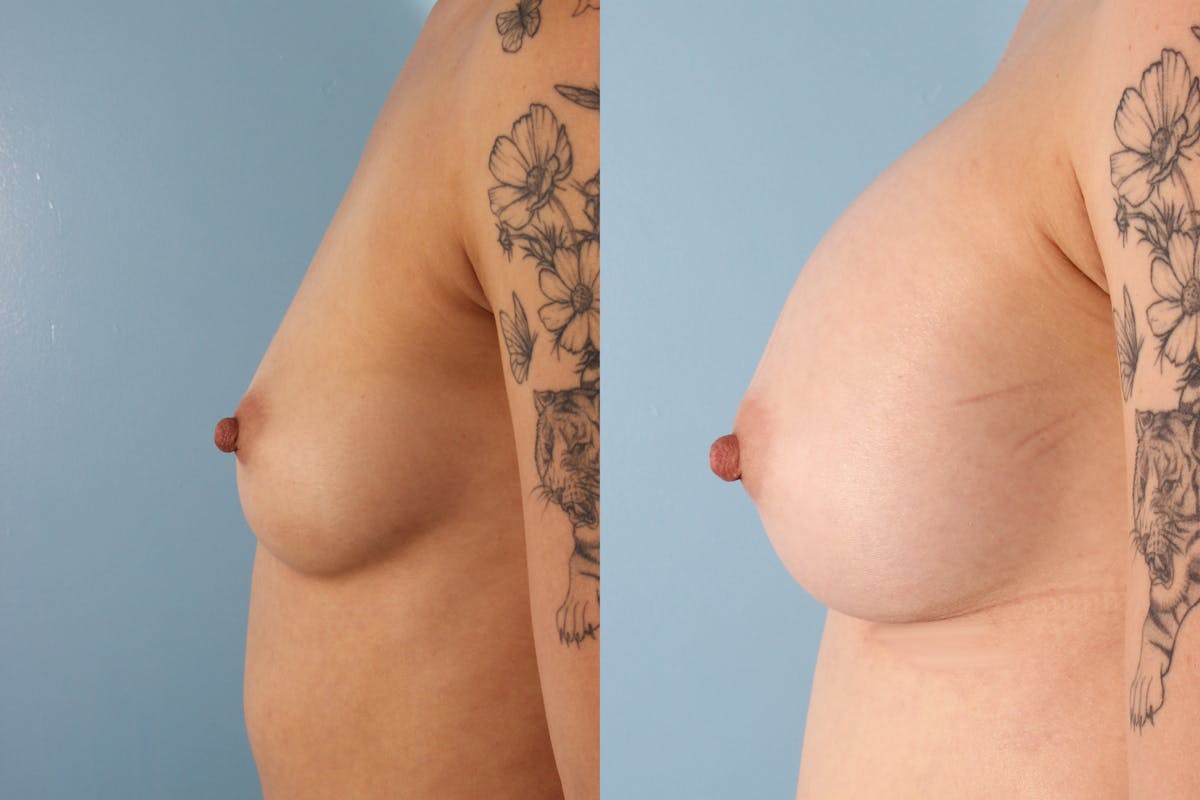 Breast Augmentation Before & After Gallery - Patient 332118 - Image 3