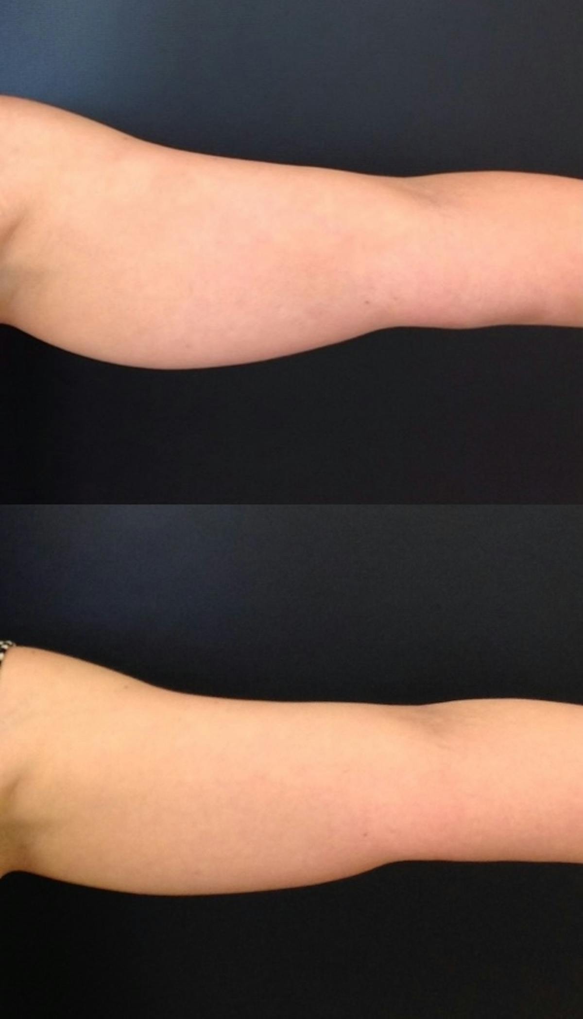 Coolsculpting Before & After Gallery - Patient 417238 - Image 1