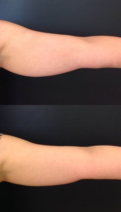 Coolsculpting Before & After Gallery - Patient 417238 - Image 1