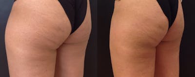 Coolsculpting Before & After Gallery - Patient 150117 - Image 1