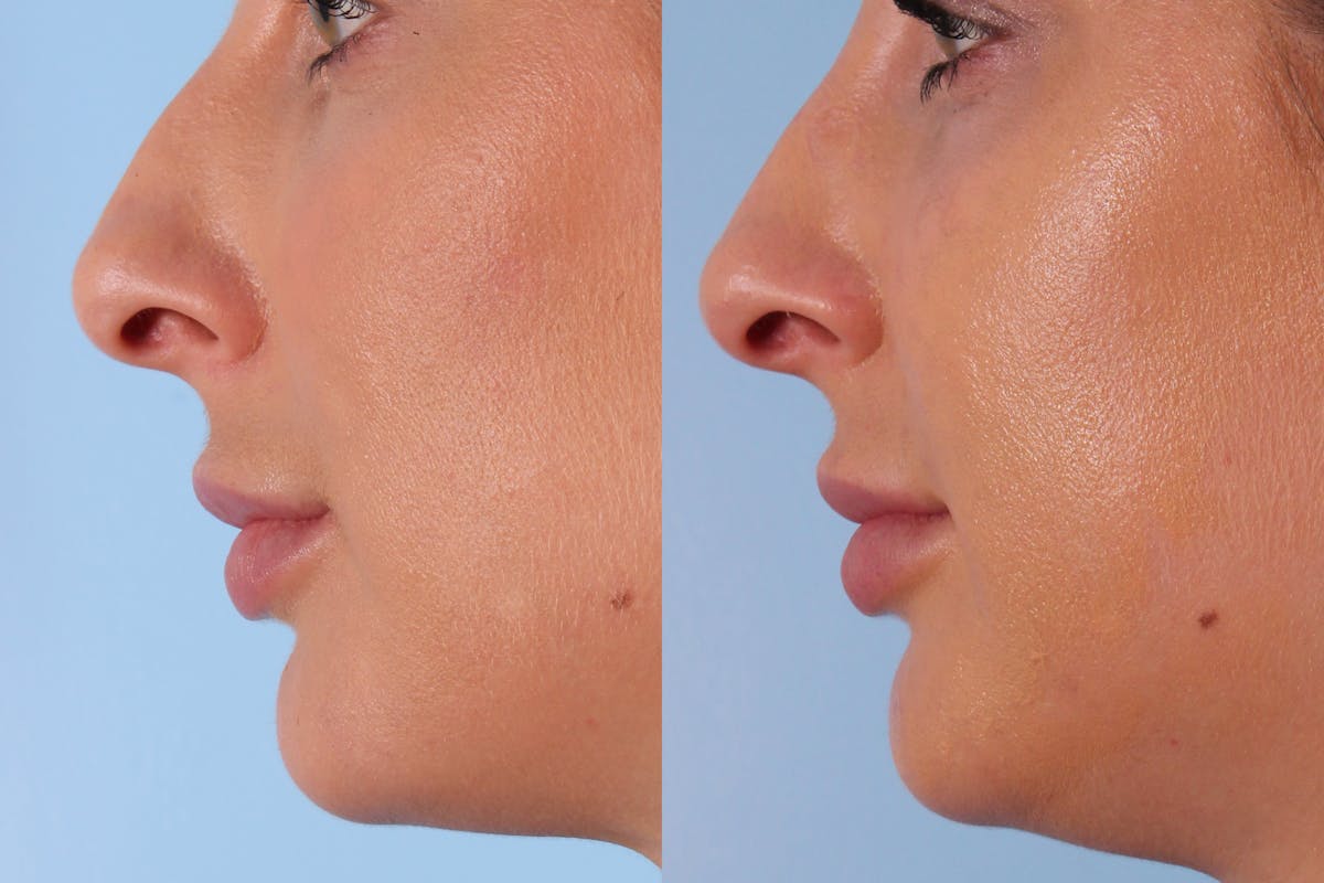 Non-Surgical Rhinoplasty Before & After Gallery - Patient 373219 - Image 1
