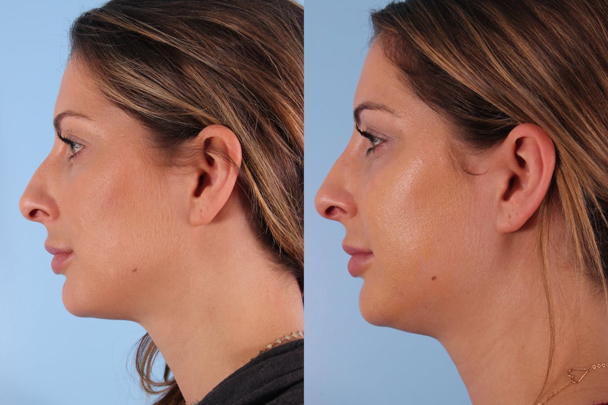 Non-Surgical Rhinoplasty Before & After Gallery - Patient 373219 - Image 2