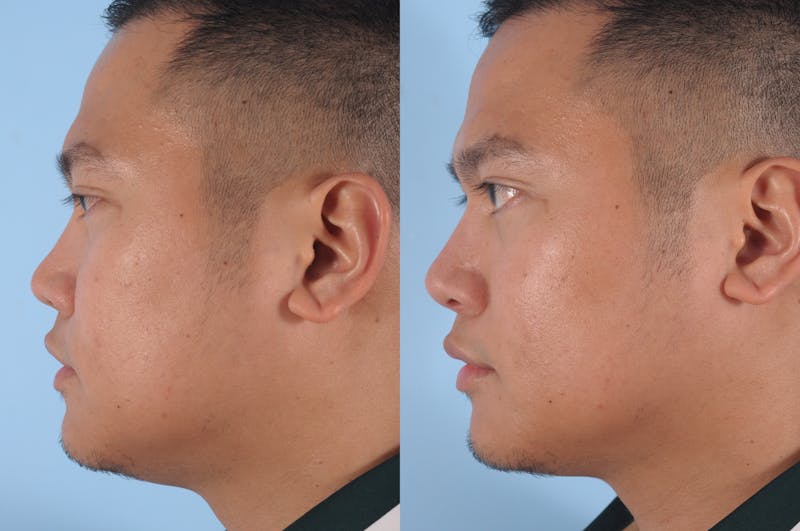 Non-Surgical Rhinoplasty Before & After Gallery - Patient 206705 - Image 1