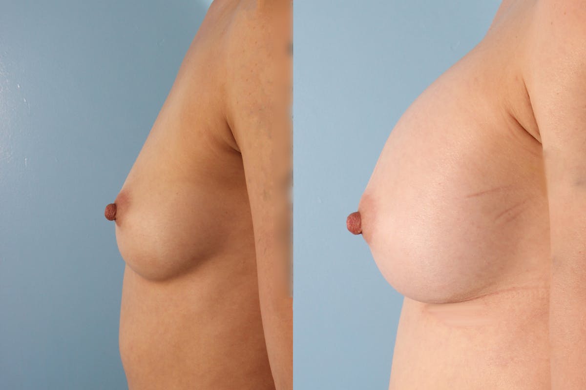 Breast Augmentation Before & After Gallery - Patient 332118 - Image 3