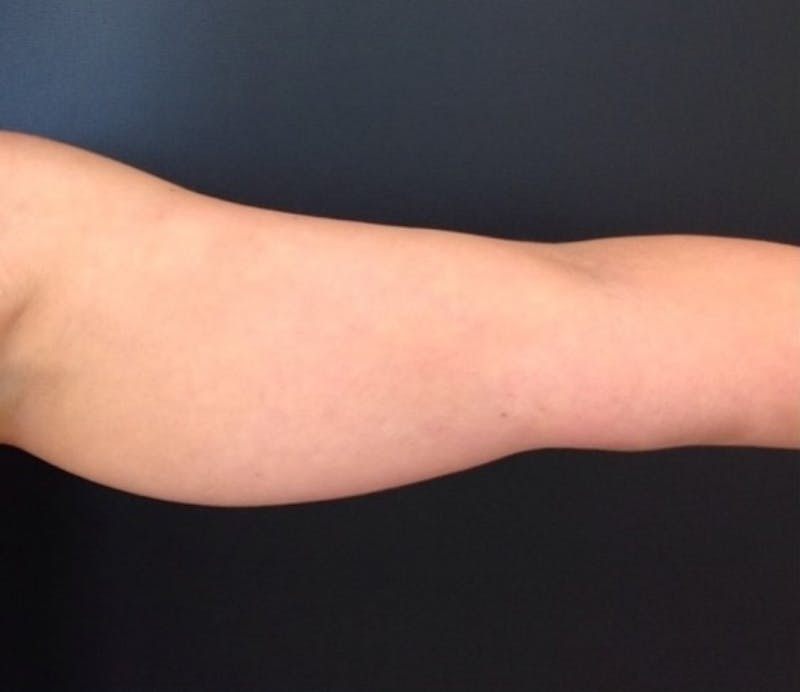 Coolsculpting Before & After Gallery - Patient 417238 - Image 1