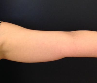 Coolsculpting Before & After Gallery - Patient 417238 - Image 2