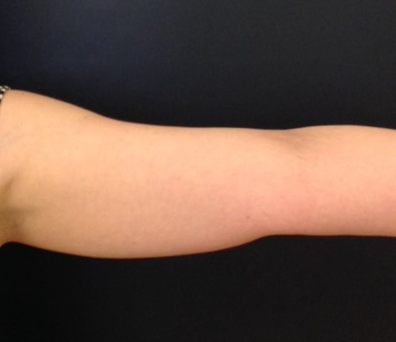 Coolsculpting Before & After Gallery - Patient 417238 - Image 2