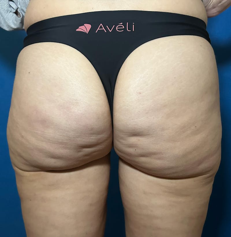 Avéli Cellulite Treatment Before & After Gallery - Patient 228800 - Image 1