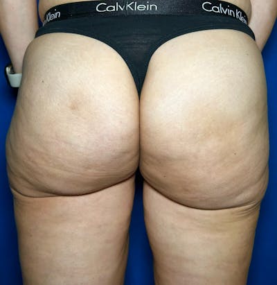 Avéli Cellulite Treatment Before & After Gallery - Patient 228800 - Image 2