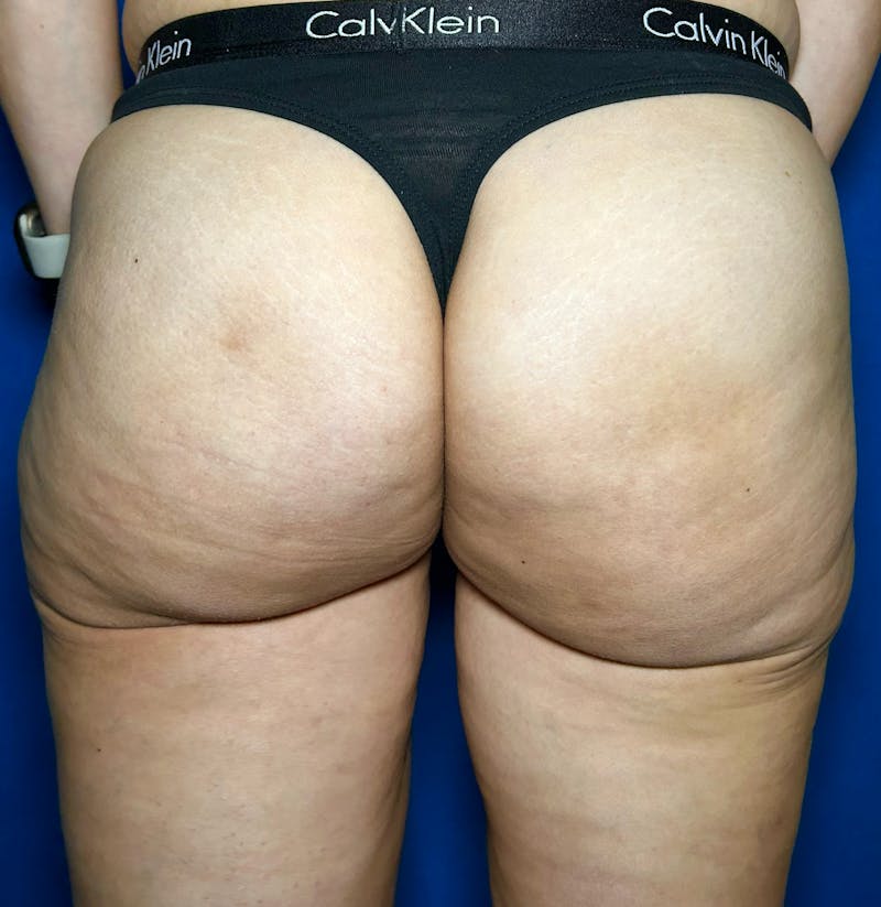 Avéli Cellulite Treatment Before & After Gallery - Patient 228800 - Image 2