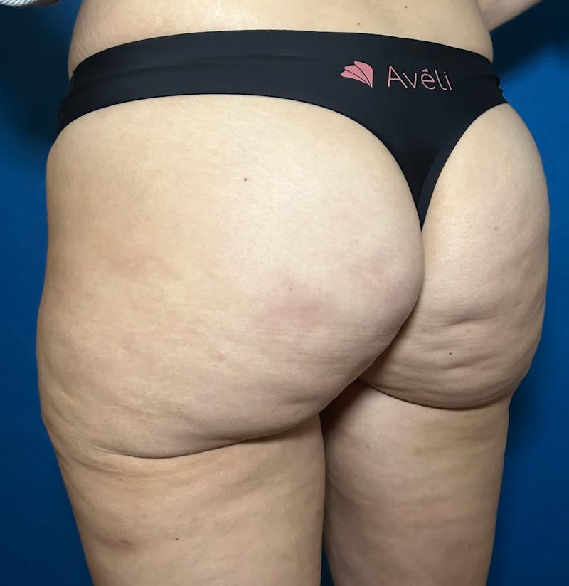 Avéli Cellulite Treatment Before & After Gallery - Patient 228800 - Image 5