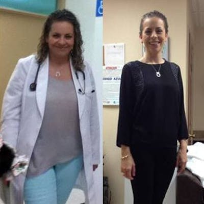Bariatric Surgery Before & After Gallery - Patient 277151 - Image 1