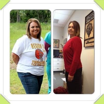 Bariatric Surgery Before & After Gallery - Patient 278250 - Image 1